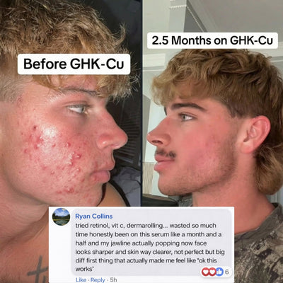 Before and after comparison of a person's face with acne treatment, featuring text about GHK-Cu and Ryan Collins' experience.
